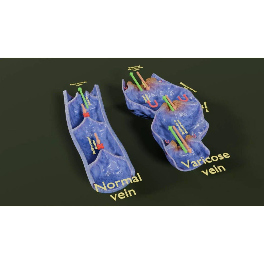 Varicose Vein Valve 3D Model – Low Poly Medical Asset, PBR Textures - View 18