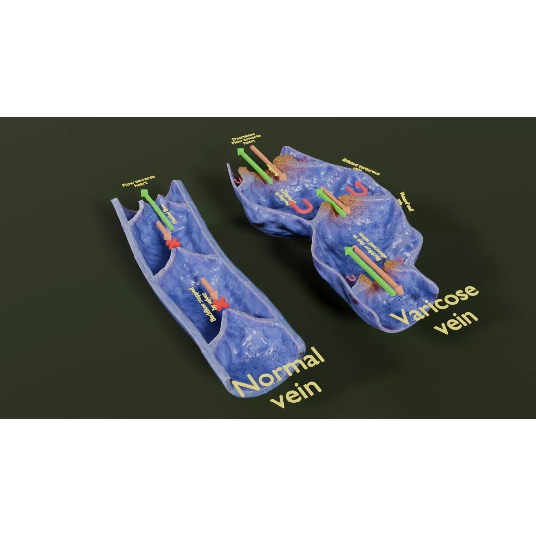 Varicose Vein Valve 3D Model – Low Poly Medical Asset, PBR Textures - View 19