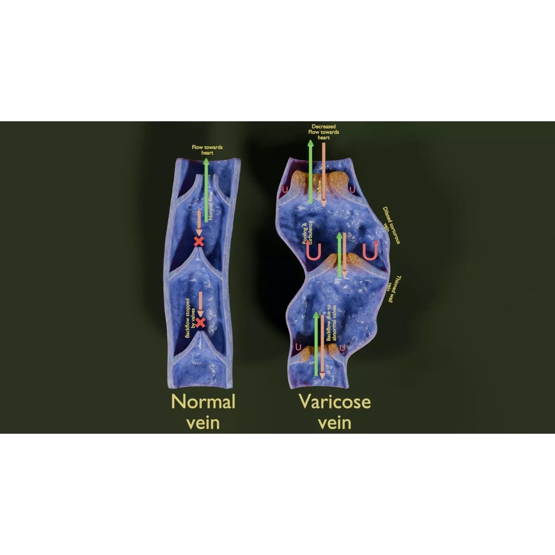 Varicose Vein Valve 3D Model – Low Poly Medical Asset, PBR Textures - View 2