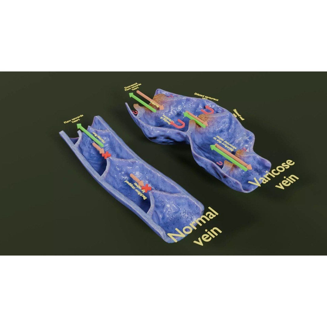 Varicose Vein Valve 3D Model – Low Poly Medical Asset, PBR Textures - View 20