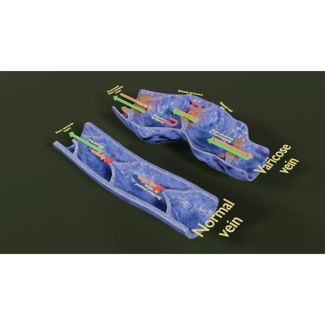 Varicose Vein Valve 3D Model – Low Poly Medical Asset, PBR Textures - View 21