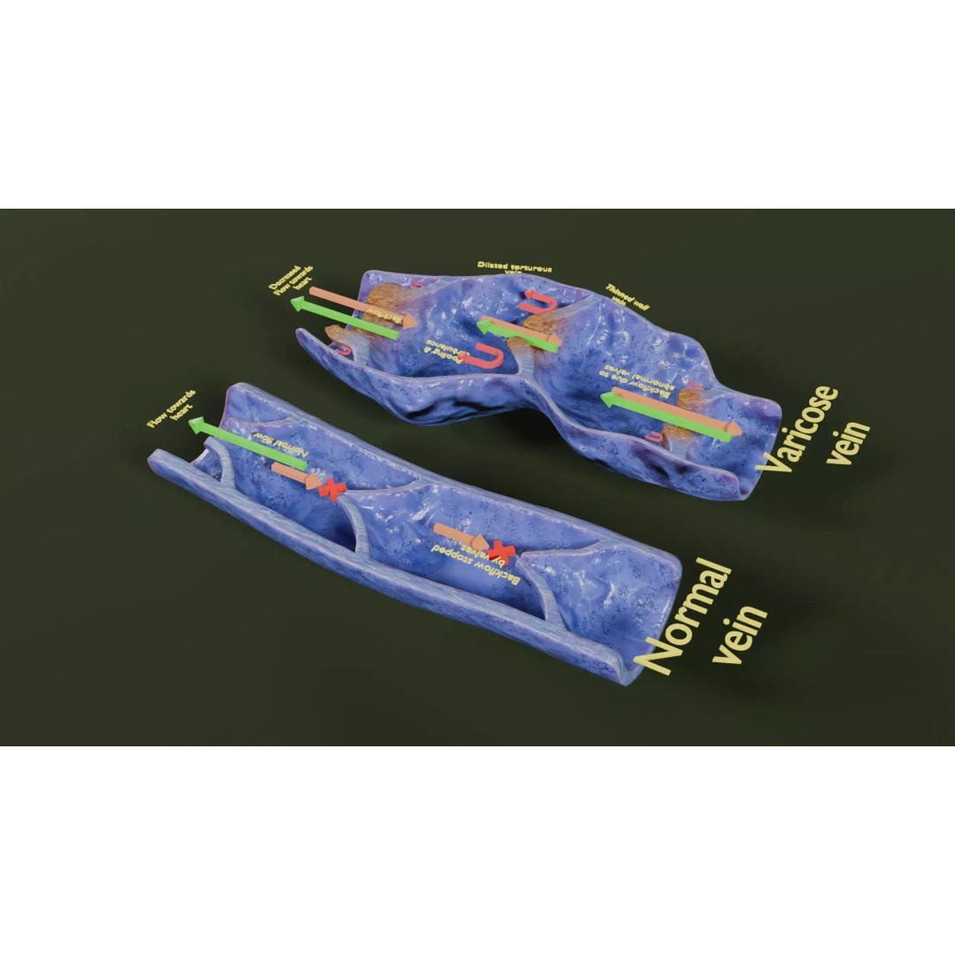 Varicose Vein Valve 3D Model – Low Poly Medical Asset, PBR Textures - View 22