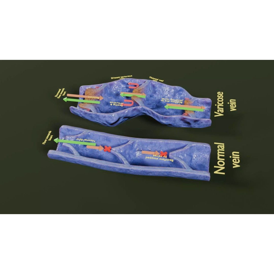 Varicose Vein Valve 3D Model – Low Poly Medical Asset, PBR Textures - View 24