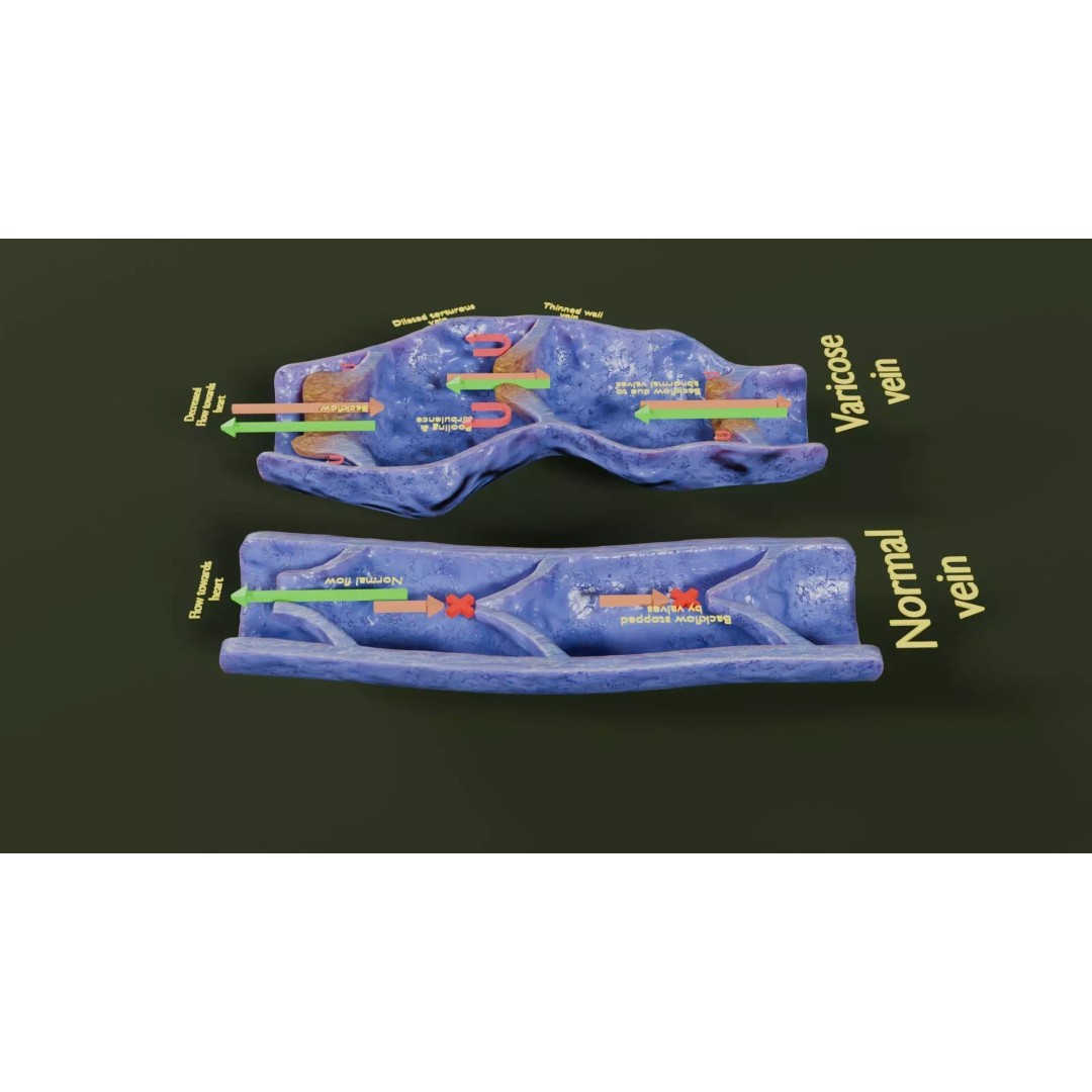Varicose Vein Valve 3D Model – Low Poly Medical Asset, PBR Textures - View 25
