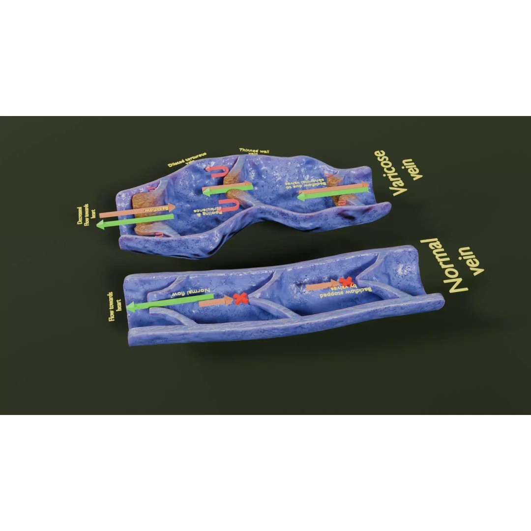 Varicose Vein Valve 3D Model – Low Poly Medical Asset, PBR Textures - View 26