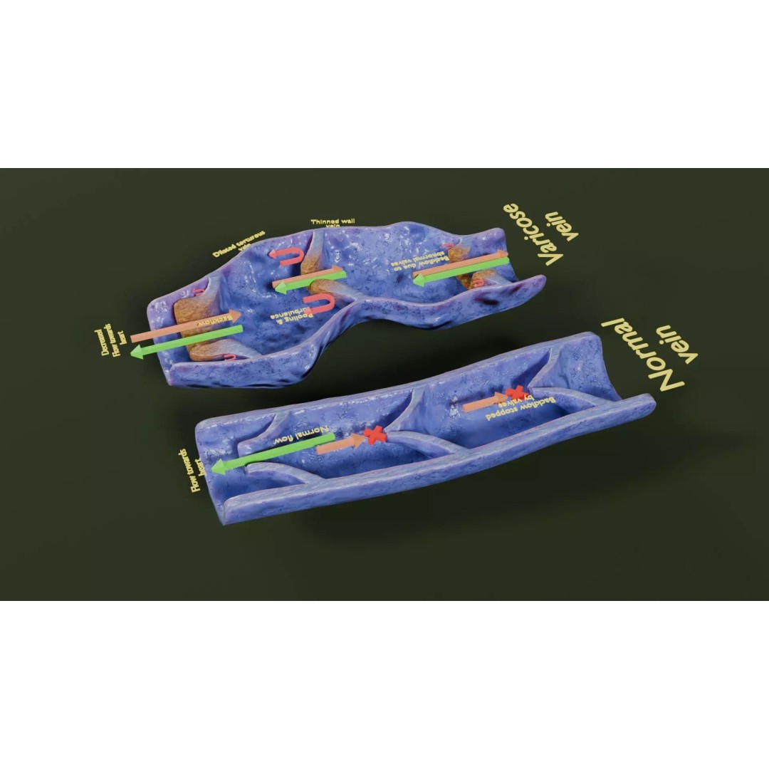 Varicose Vein Valve 3D Model – Low Poly Medical Asset, PBR Textures - View 27