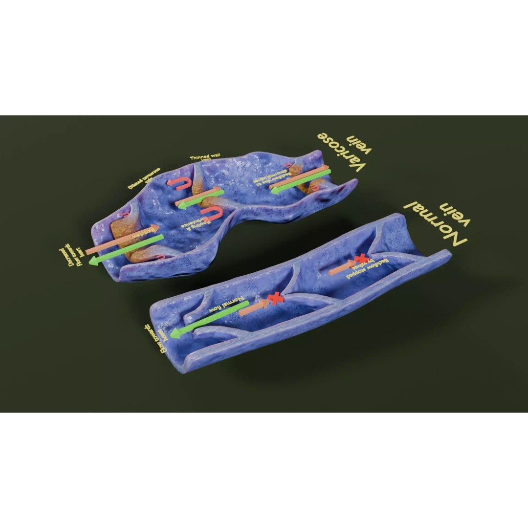 Varicose Vein Valve 3D Model – Low Poly Medical Asset, PBR Textures - View 28