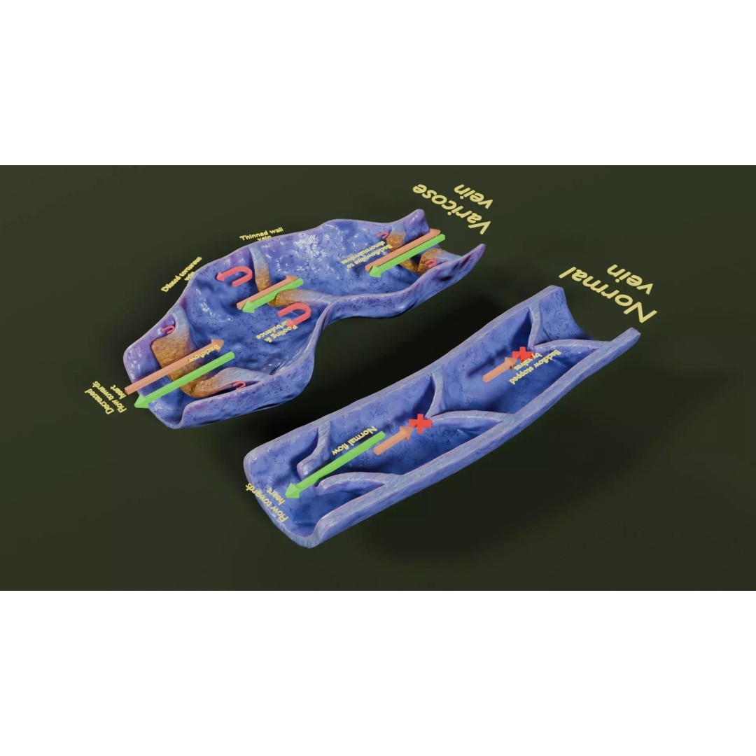Varicose Vein Valve 3D Model – Low Poly Medical Asset, PBR Textures - View 29