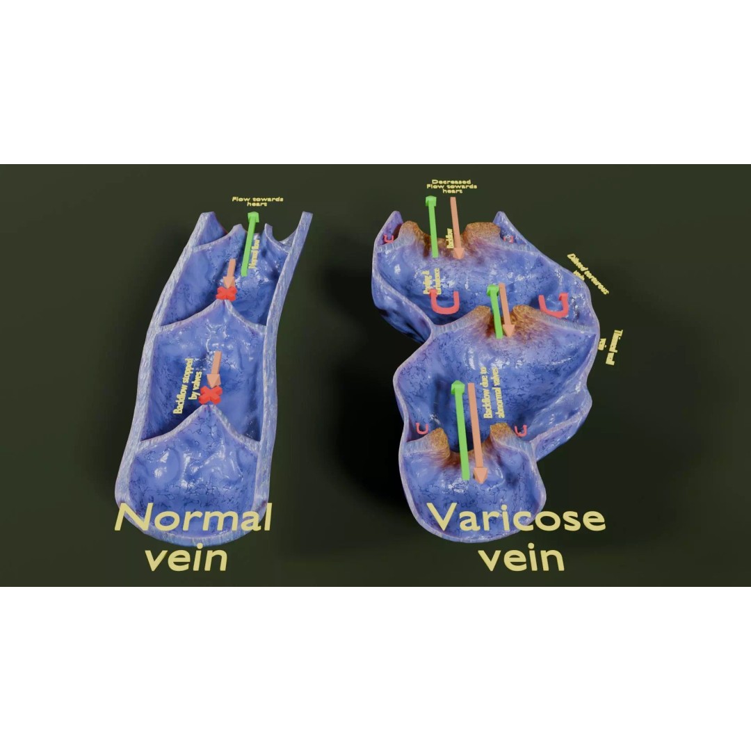 Varicose Vein Valve 3D Model – Low Poly Medical Asset, PBR Textures - View 3
