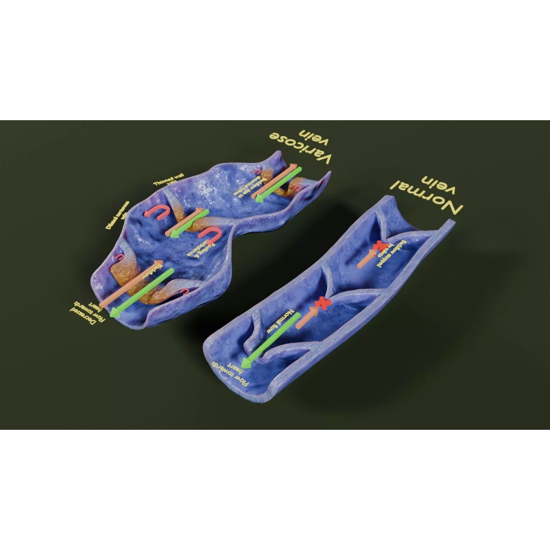 Varicose Vein Valve 3D Model – Low Poly Medical Asset, PBR Textures - View 30