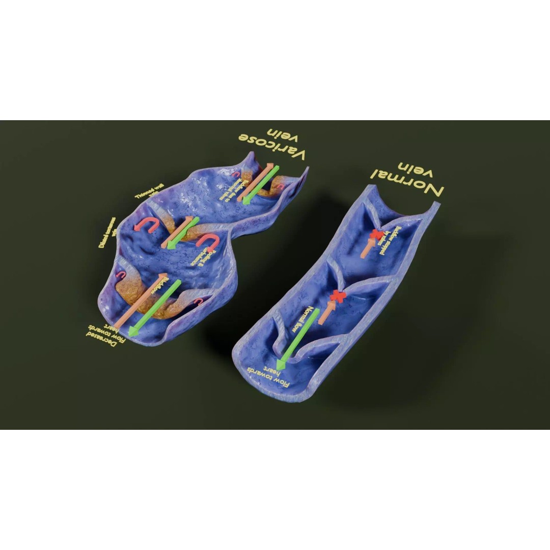 Varicose Vein Valve 3D Model – Low Poly Medical Asset, PBR Textures - View 31