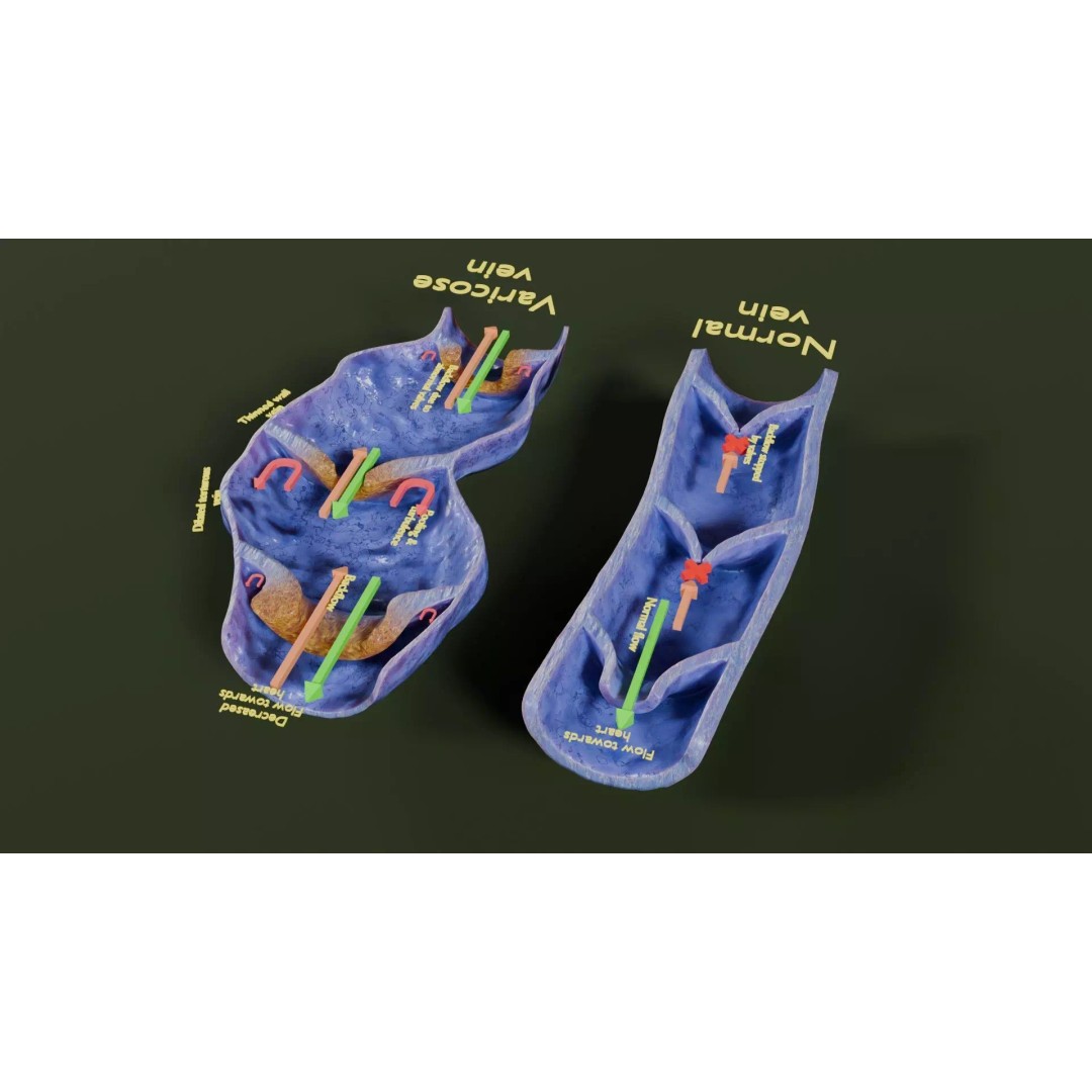 Varicose Vein Valve 3D Model – Low Poly Medical Asset, PBR Textures - View 32