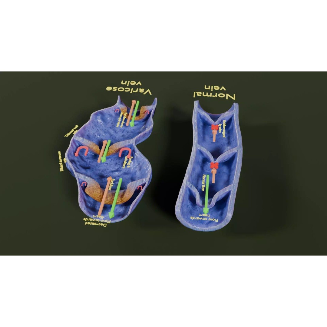 Varicose Vein Valve 3D Model – Low Poly Medical Asset, PBR Textures - View 33