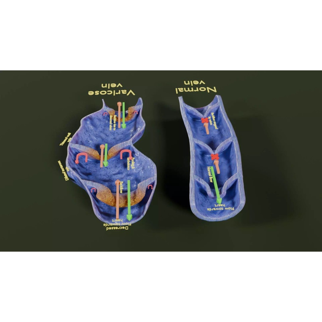Varicose Vein Valve 3D Model – Low Poly Medical Asset, PBR Textures - View 34