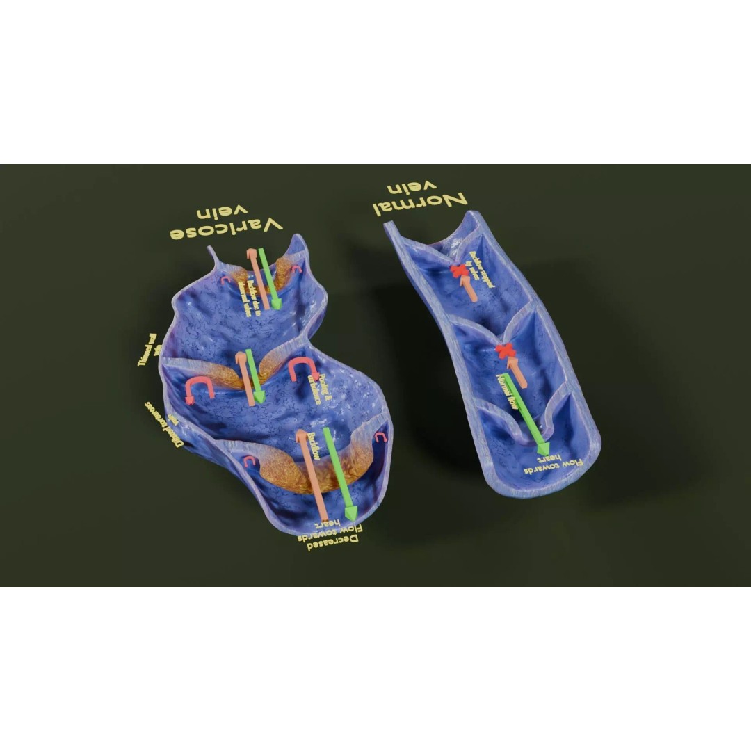 Varicose Vein Valve 3D Model – Low Poly Medical Asset, PBR Textures - View 35