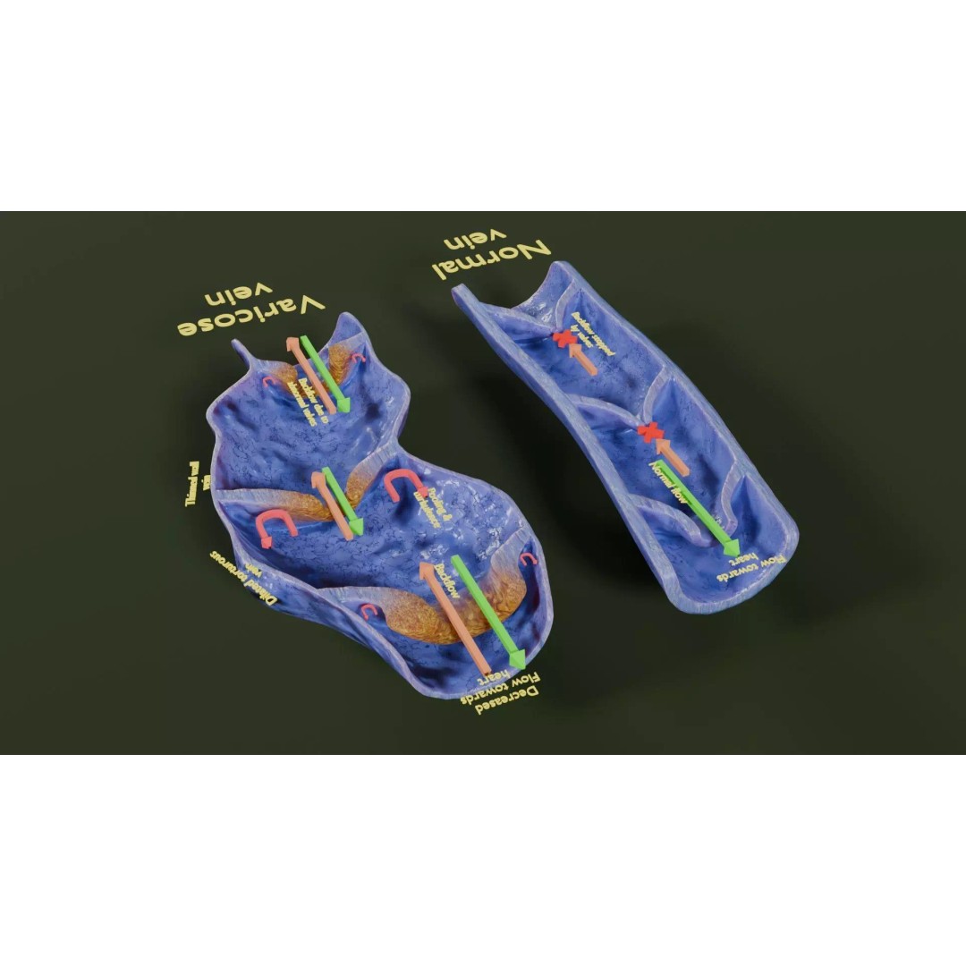 Varicose Vein Valve 3D Model – Low Poly Medical Asset, PBR Textures - View 36