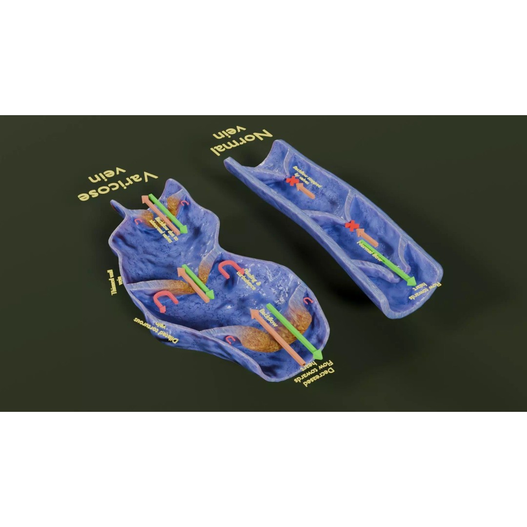 Varicose Vein Valve 3D Model – Low Poly Medical Asset, PBR Textures - View 37