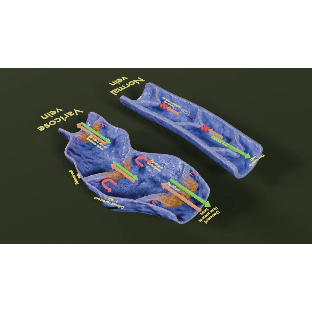 Varicose Vein Valve 3D Model – Low Poly Medical Asset, PBR Textures - View 38