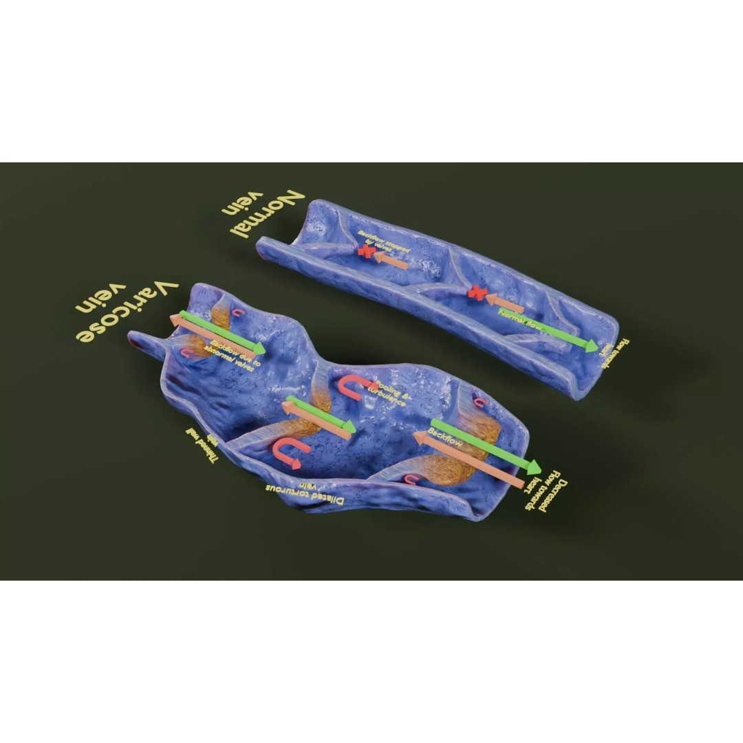 Varicose Vein Valve 3D Model – Low Poly Medical Asset, PBR Textures - View 39