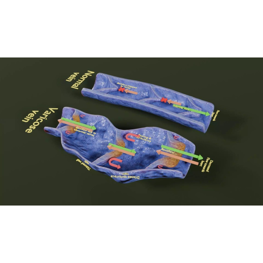 Varicose Vein Valve 3D Model – Low Poly Medical Asset, PBR Textures - View 40