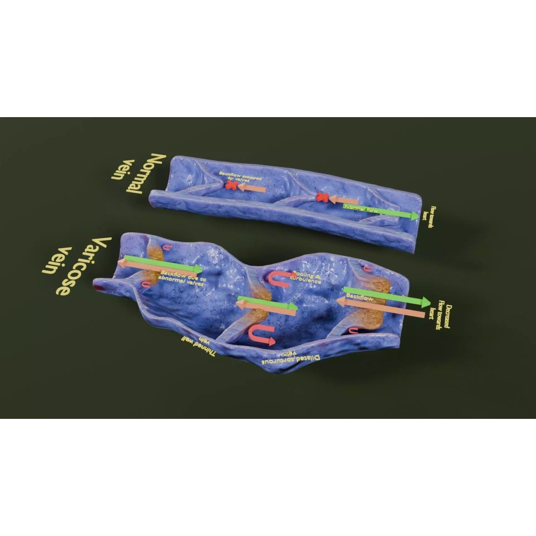 Varicose Vein Valve 3D Model – Low Poly Medical Asset, PBR Textures - View 41