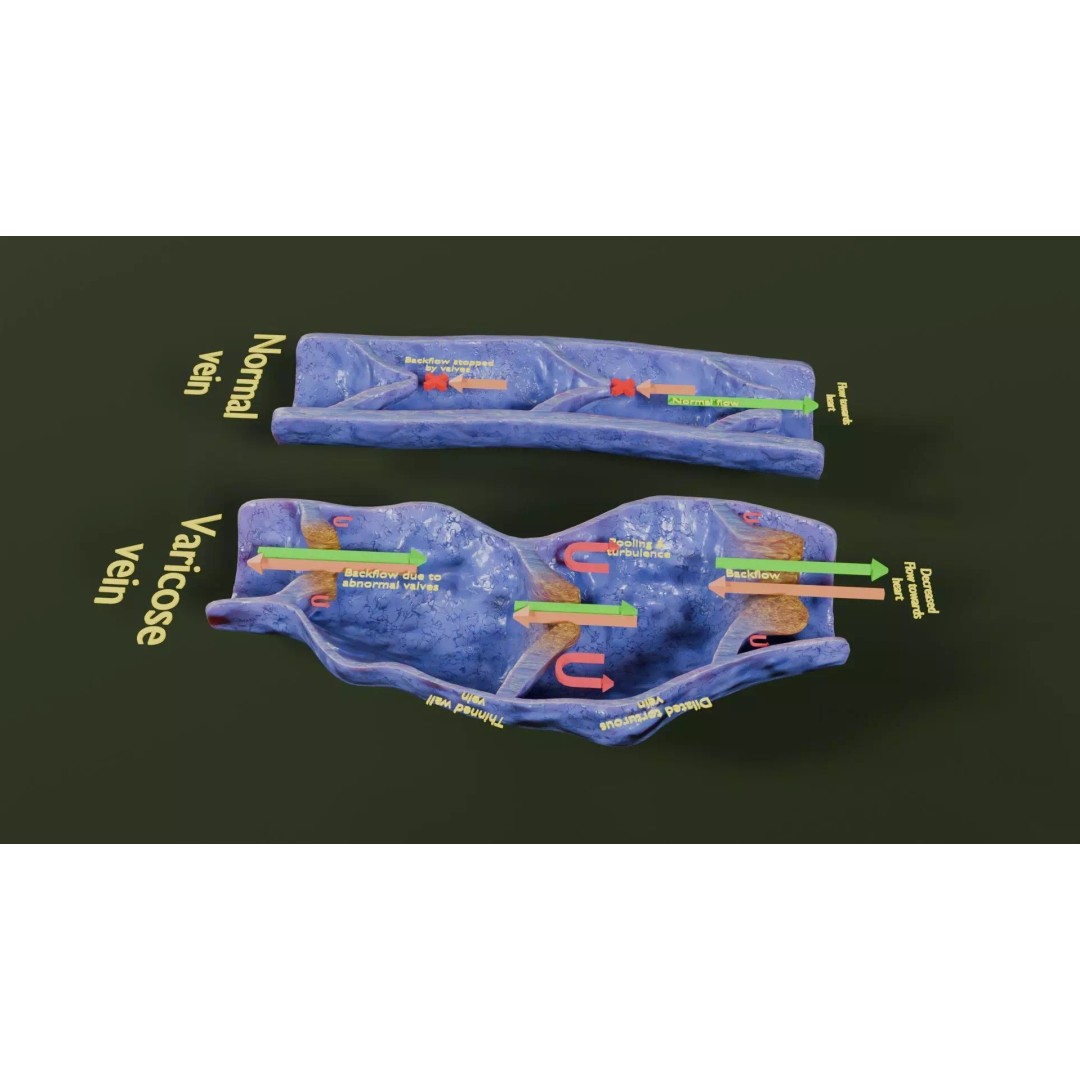 Varicose Vein Valve 3D Model – Low Poly Medical Asset, PBR Textures - View 42