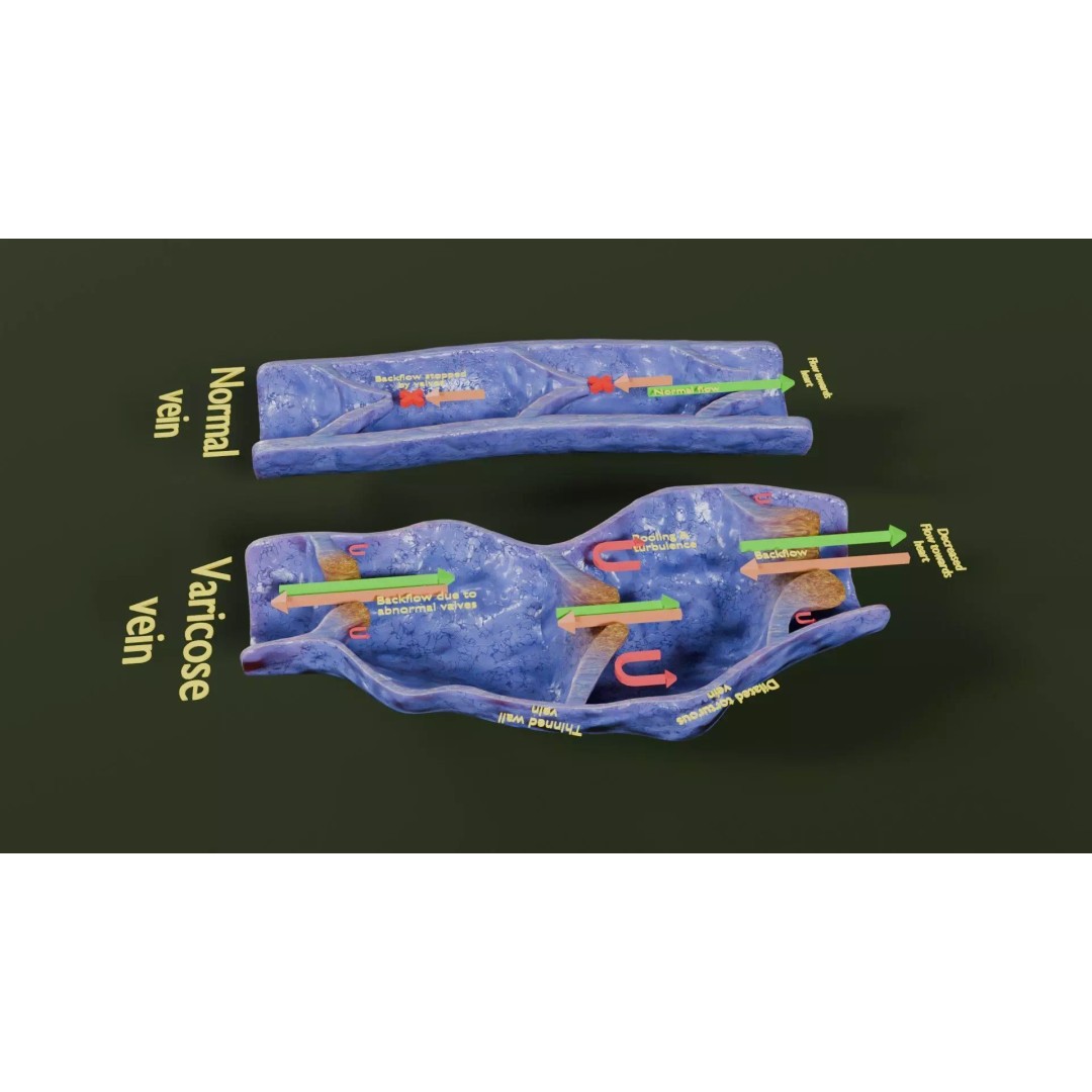 Varicose Vein Valve 3D Model – Low Poly Medical Asset, PBR Textures - View 43