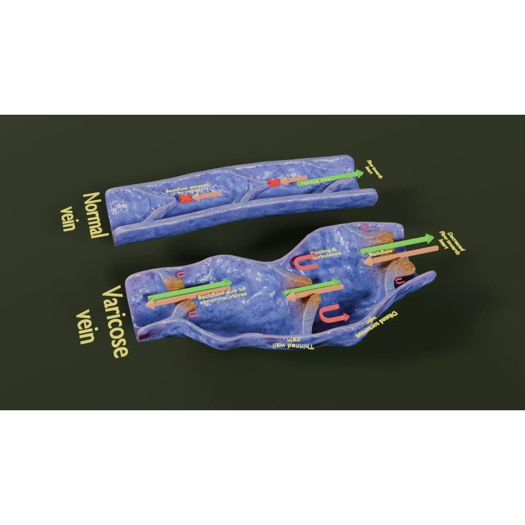 Varicose Vein Valve 3D Model – Low Poly Medical Asset, PBR Textures - View 44