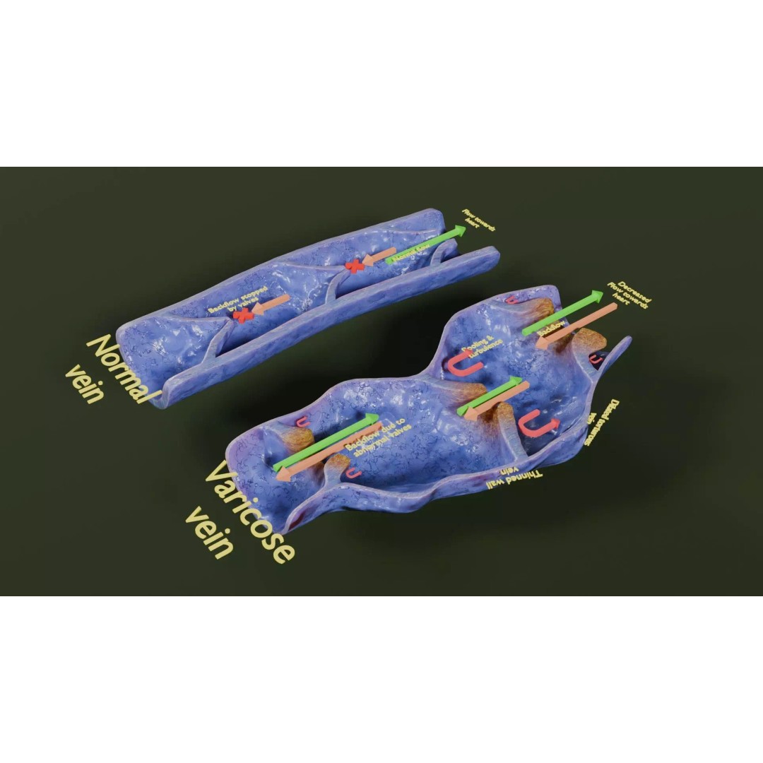 Varicose Vein Valve 3D Model – Low Poly Medical Asset, PBR Textures - View 46