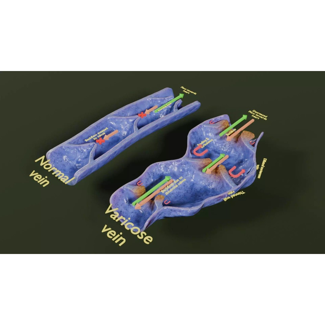 Varicose Vein Valve 3D Model – Low Poly Medical Asset, PBR Textures - View 47
