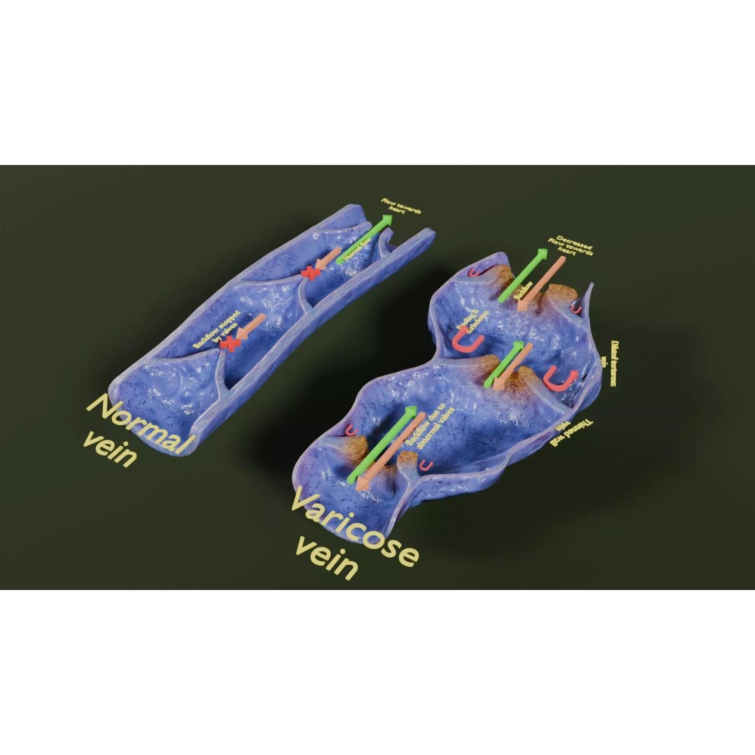 Varicose Vein Valve 3D Model – Low Poly Medical Asset, PBR Textures - View 48