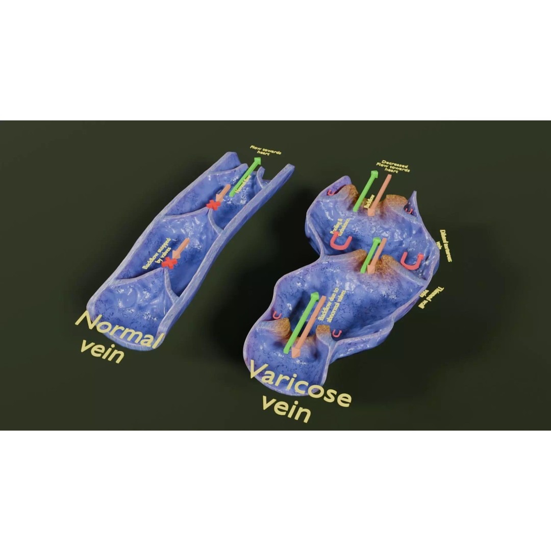 Varicose Vein Valve 3D Model – Low Poly Medical Asset, PBR Textures - View 49