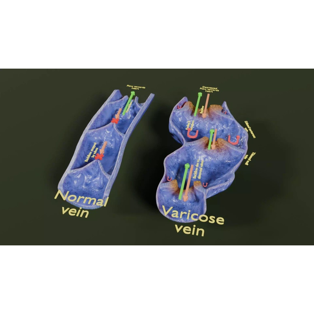 Varicose Vein Valve 3D Model – Low Poly Medical Asset, PBR Textures - View 50