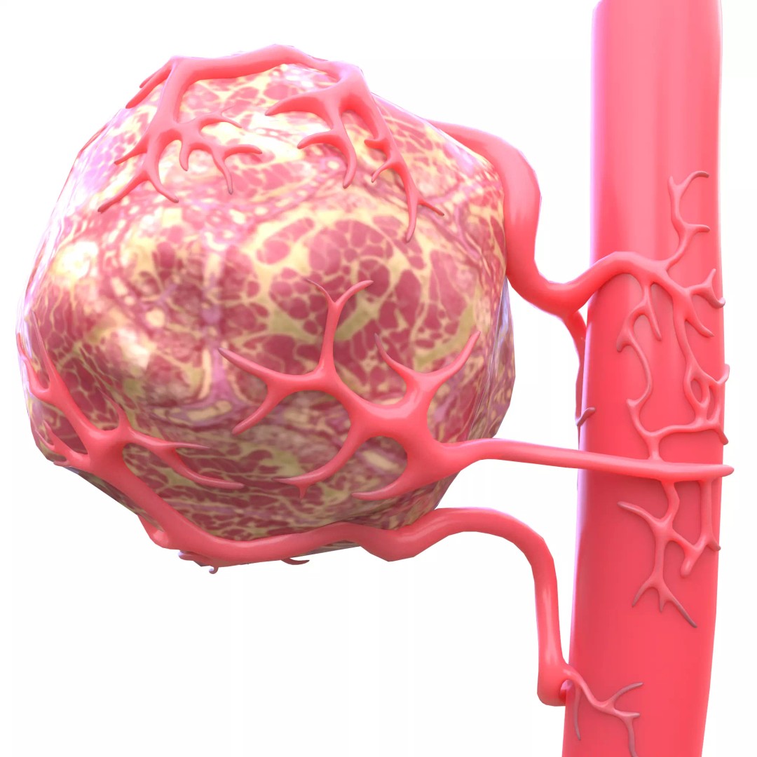 Tumor 3D Model – Low Poly Anatomy Asset with PBR Textures - View 2