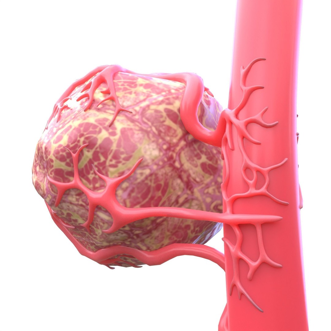 Tumor 3D Model – Low Poly Anatomy Asset with PBR Textures - View 3