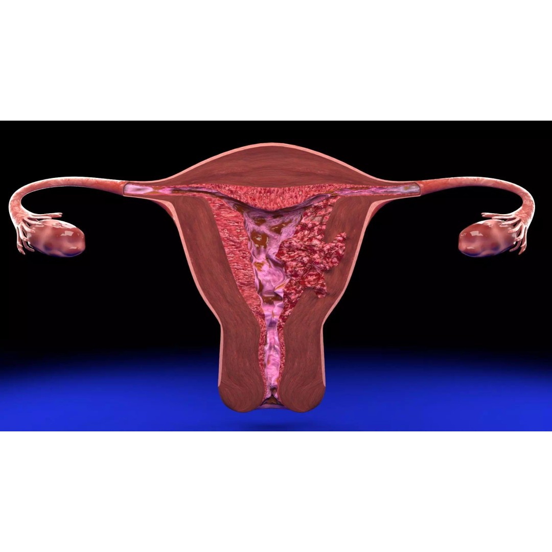 Uterus 3D Model – Low Poly Endometrial Lesions Set for Medical Use - View 10