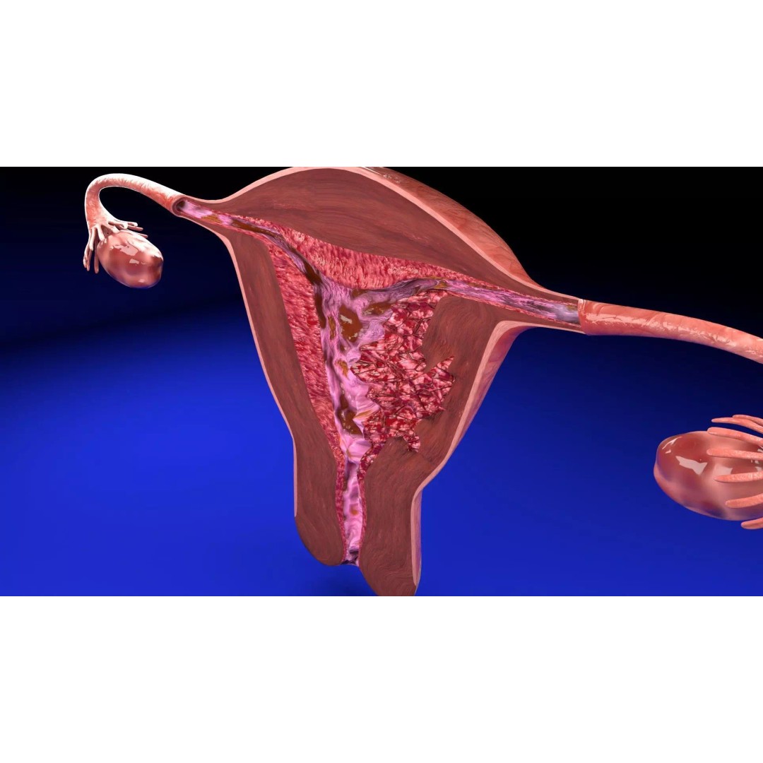 Uterus 3D Model – Low Poly Endometrial Lesions Set for Medical Use - View 11