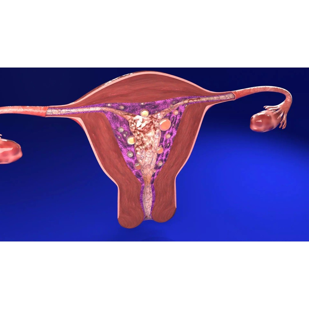 Uterus 3D Model – Low Poly Endometrial Lesions Set for Medical Use - View 14