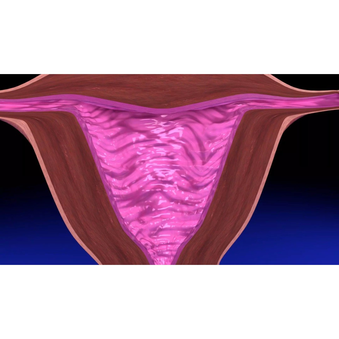 Uterus 3D Model – Low Poly Endometrial Lesions Set for Medical Use - View 17