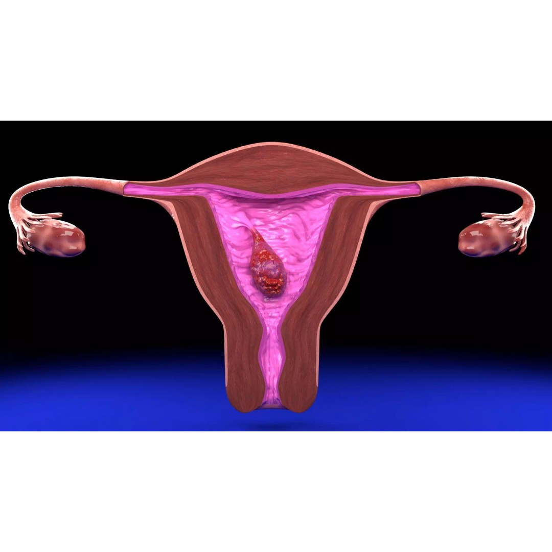 Uterus 3D Model – Low Poly Endometrial Lesions Set for Medical Use - View 19