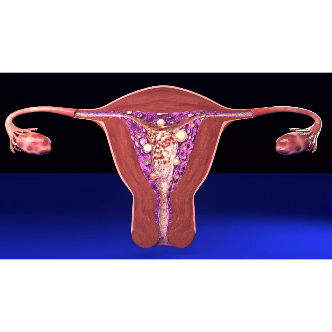 Uterus 3D Model – Low Poly Endometrial Lesions Set for Medical Use - View 2