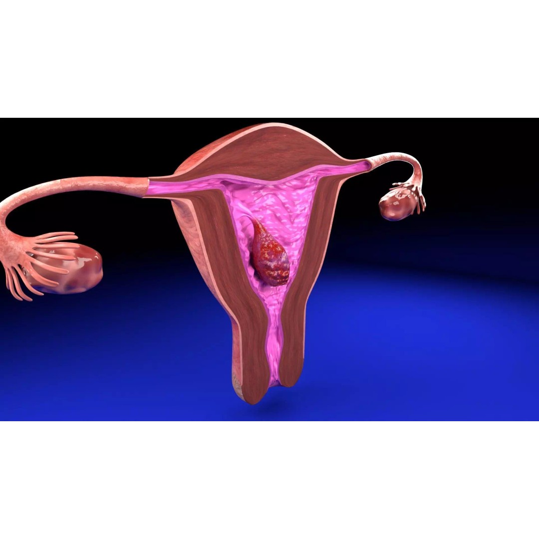 Uterus 3D Model – Low Poly Endometrial Lesions Set for Medical Use - View 20