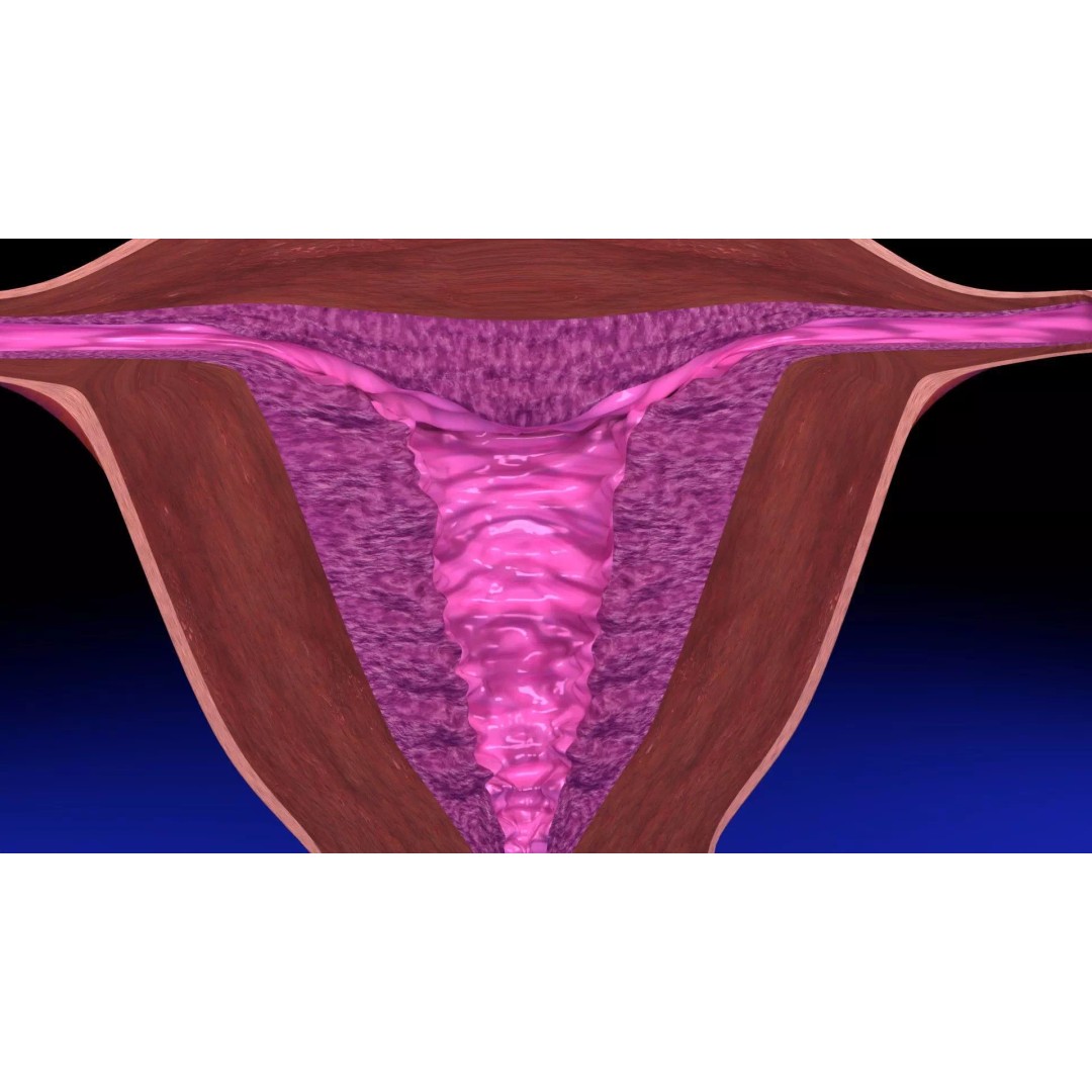Uterus 3D Model – Low Poly Endometrial Lesions Set for Medical Use - View 24