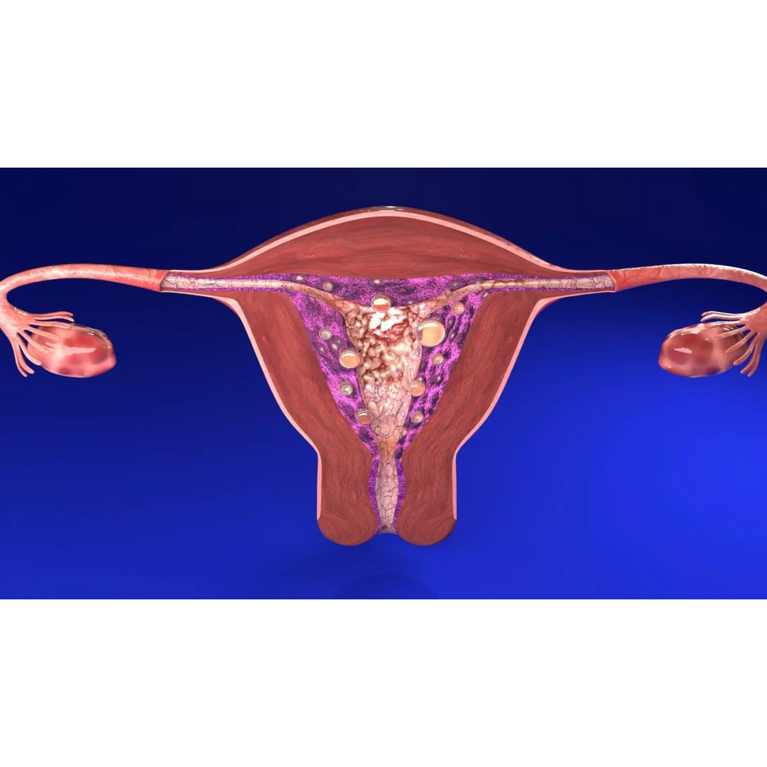 Uterus 3D Model – Low Poly Endometrial Lesions Set for Medical Use - View 29