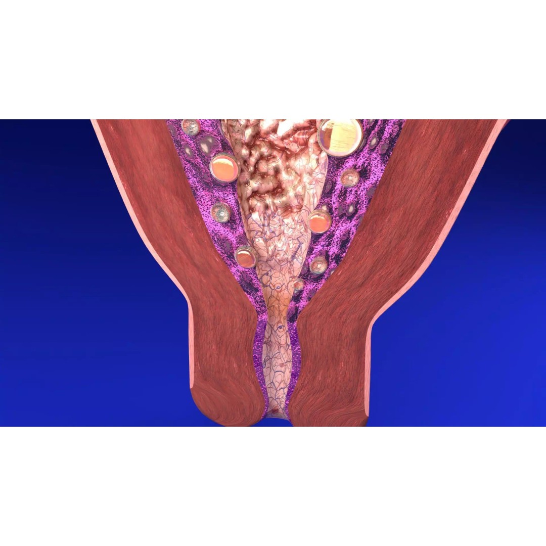 Uterus 3D Model – Low Poly Endometrial Lesions Set for Medical Use - View 3
