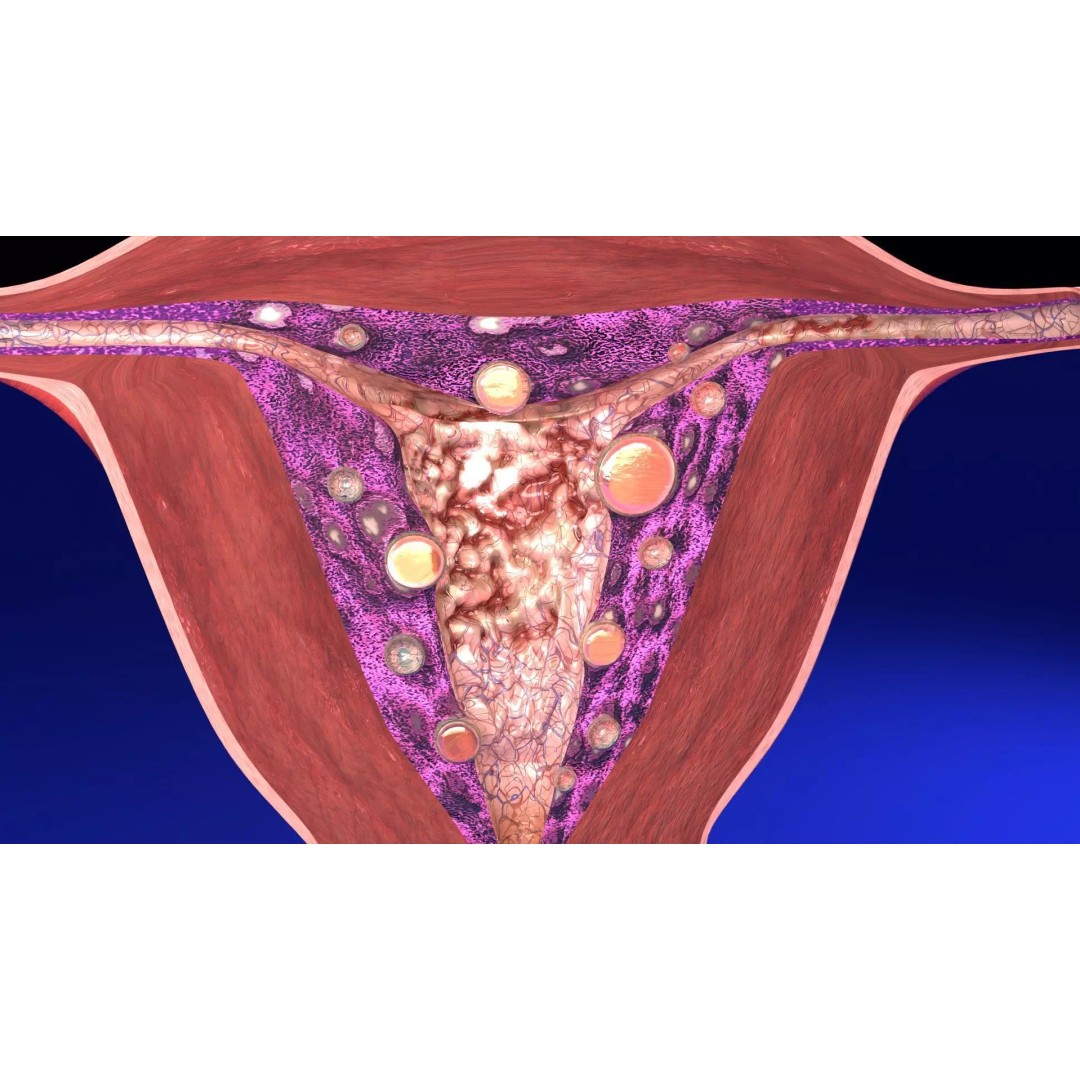 Uterus 3D Model – Low Poly Endometrial Lesions Set for Medical Use - View 4