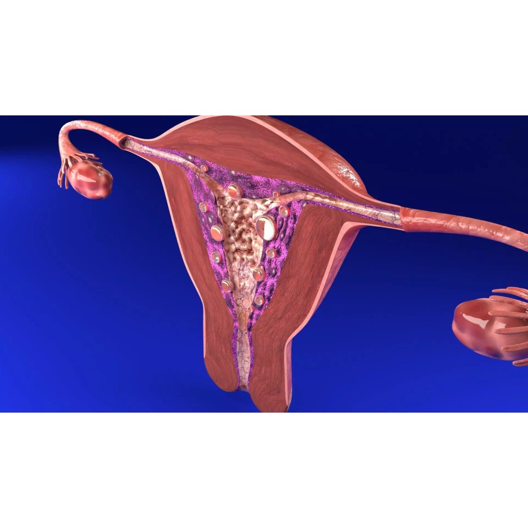 Uterus 3D Model – Low Poly Endometrial Lesions Set for Medical Use - View 5