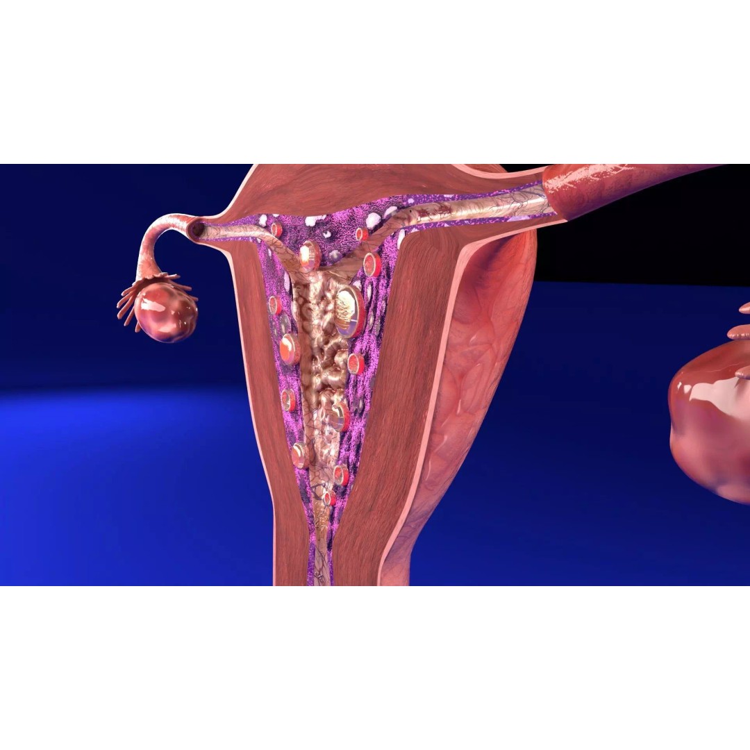 Uterus 3D Model – Low Poly Endometrial Lesions Set for Medical Use - View 6