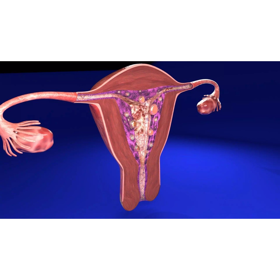 Uterus 3D Model – Low Poly Endometrial Lesions Set for Medical Use - View 7