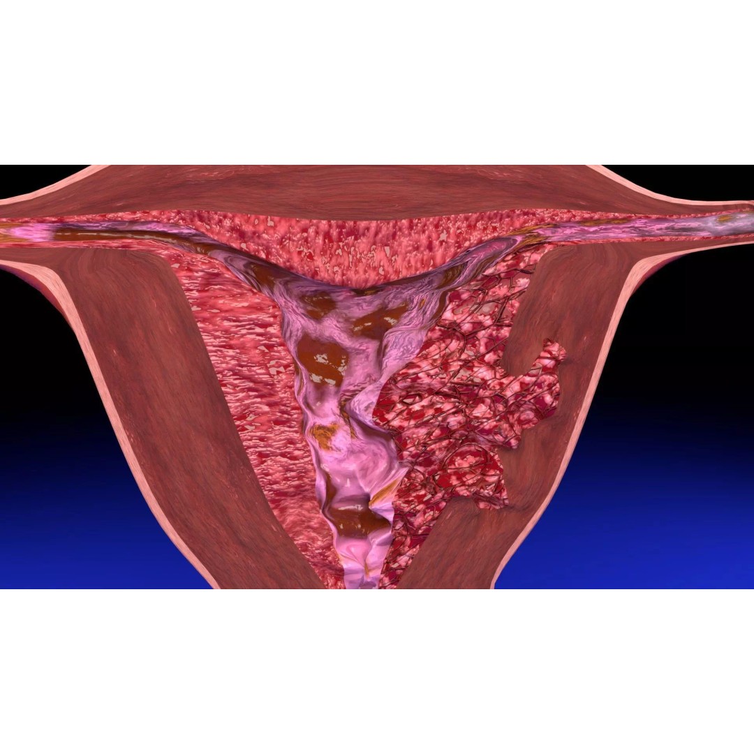 Uterus 3D Model – Low Poly Endometrial Lesions Set for Medical Use - View 8